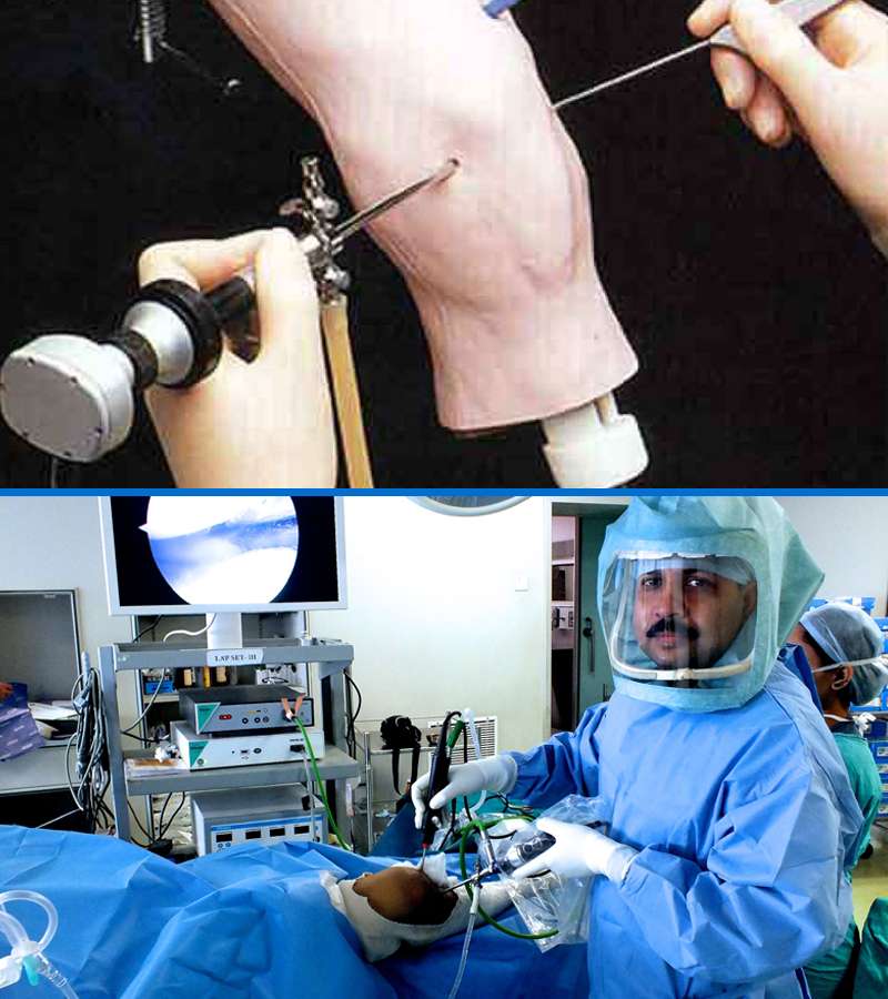 knee-arthroscopic