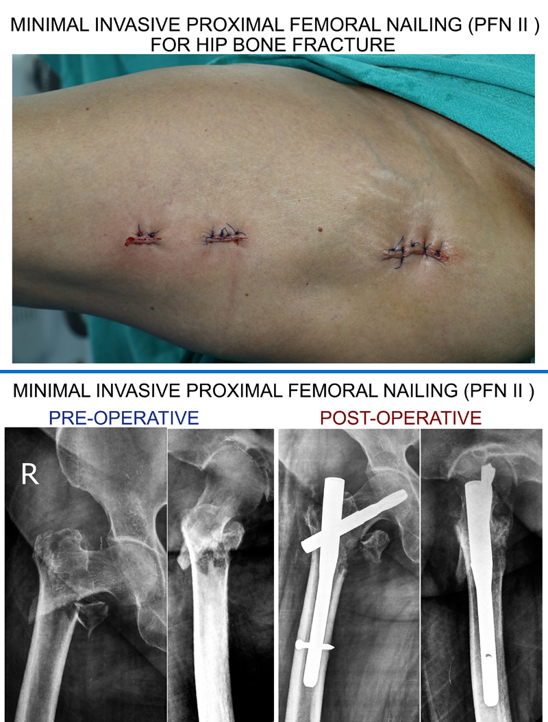 minimally-invasive-fracture-surgery01