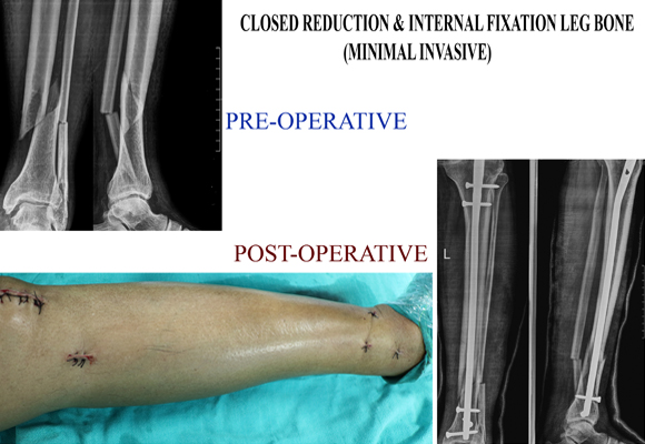 minimally-invasive-fracture-surgery02