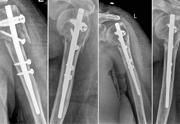 minimally-invasive-fracture-surgery03