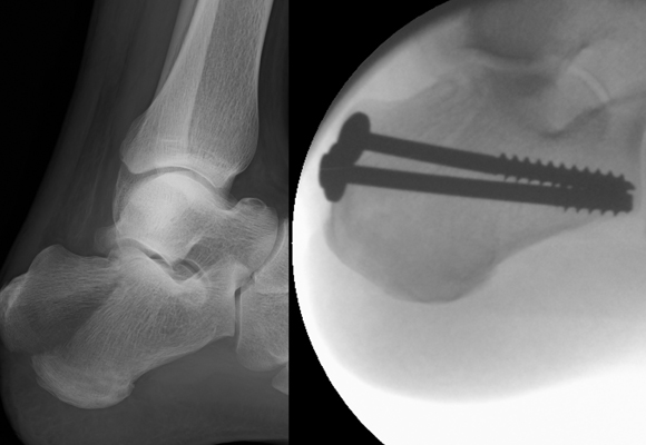 minimally-invasive-fracture-surgery04