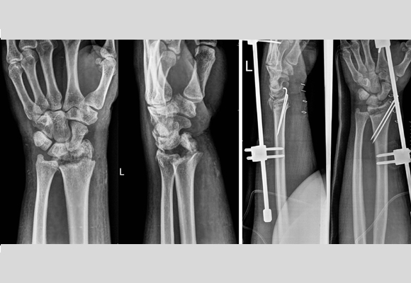 minimally-invasive-fracture-surgery06