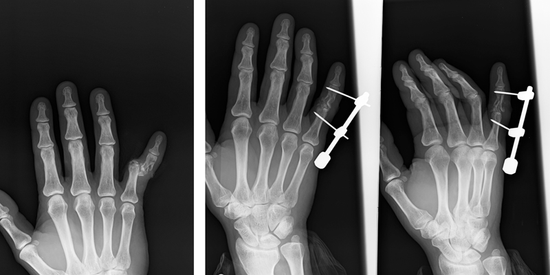 minimally-invasive-fracture-surgery08
