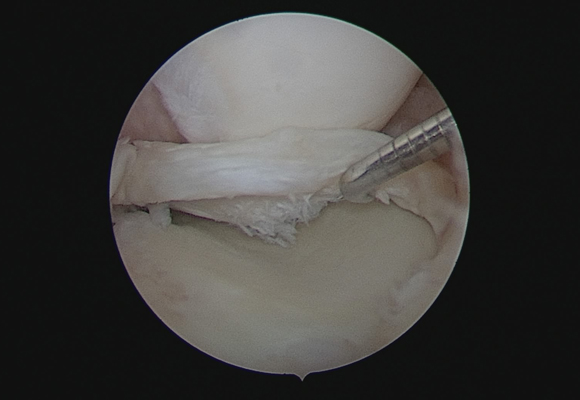 torn-meniscus